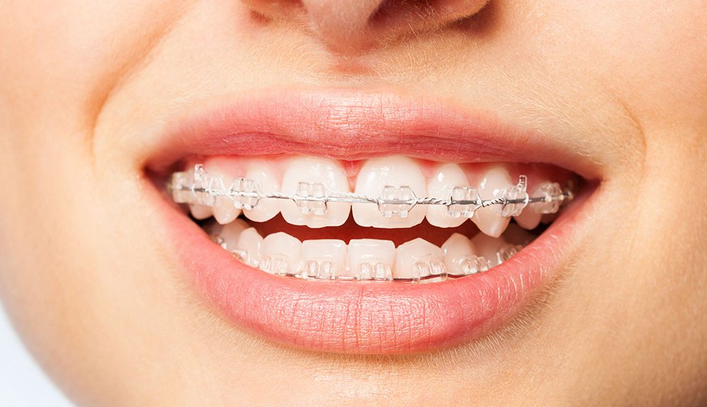 foods you can't eat with metal braces